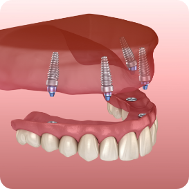 Illustration of a full denture being supported by four dental implants